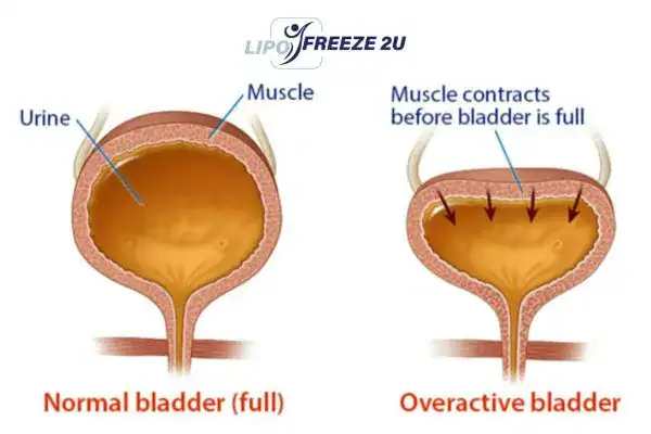 diagram of overactive bladder treatment Broxburn