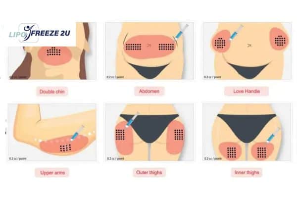 Benefits of Choosing Aqualyx for Fat Reduction Broxburn