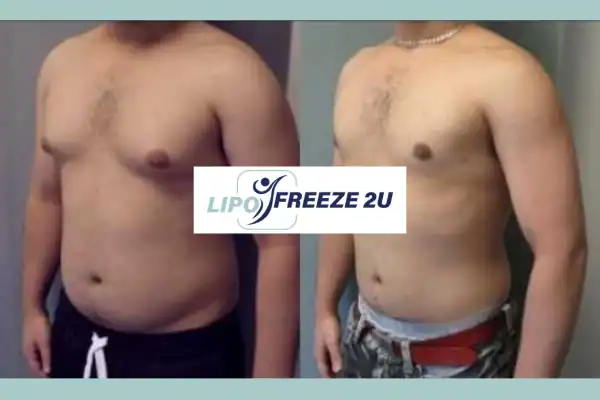 How Long Does It Take to See Results Broxburn?