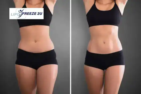 How Can LIPO FREEZE 2U Support Your Post-Pregnancy Body Recovery Broxburn?
