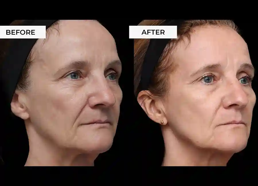 How Many RF Microneedling Sessions Will You Need to See a Difference Broxburn?