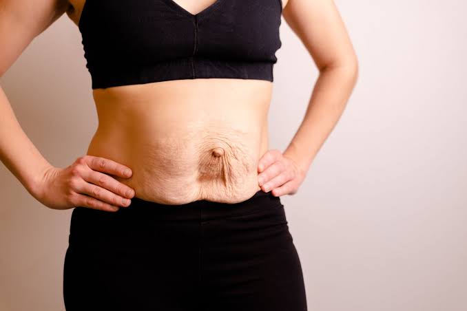 Is Surgery Really the Only Way to Repair Diastasis Recti Broxburn?