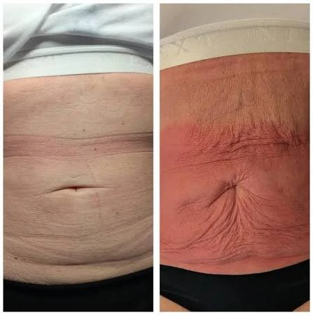 How Does RF Microneedling Improve Crepey, Thin and Uneven Skin Texture Broxburn?