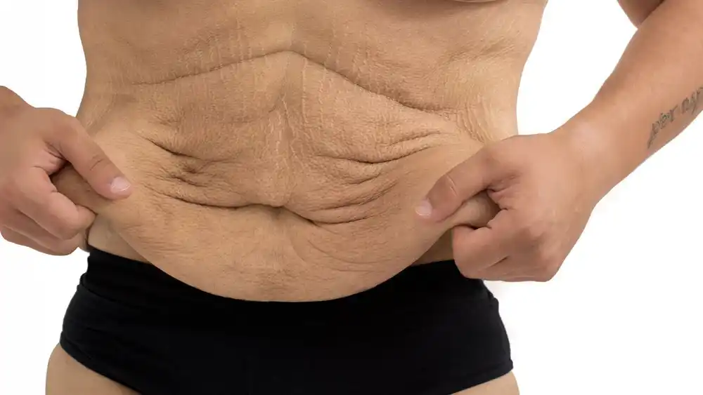 Why Does Weight Loss Medication Leave Some People With Loose or Sagging Skin Broxburn?